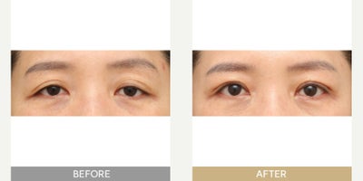Eyelid Surgery before and after photo