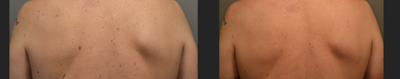 IPL before and after photo