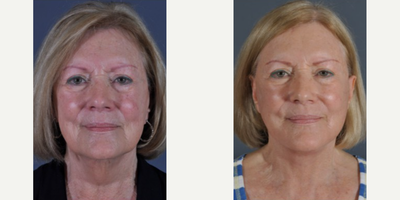 Neck Lift before and after photo