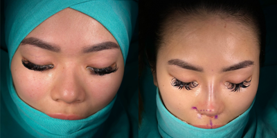 Asian Rhinoplasty before and after photo