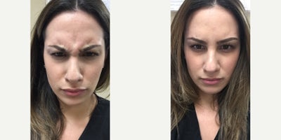 Botox before and after photo