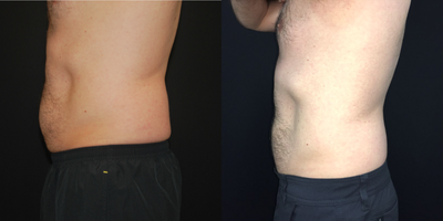 CoolSculpting before and after photo