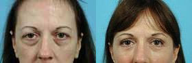 Eyelid Surgery before and after photo