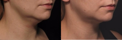 Kybella before and after photo