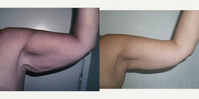 Arm Lift before and after photo