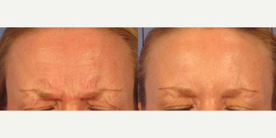 Botox before and after photo