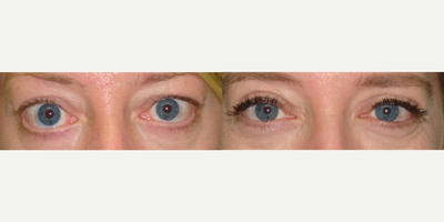 Eyelid Retraction Repair before and after photo