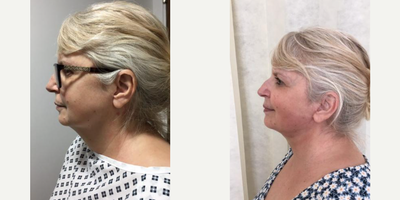 Facelift before and after photo