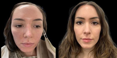 Forehead Reduction before and after photo