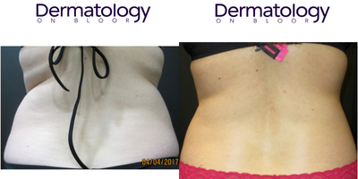CoolSculpting before and after photo