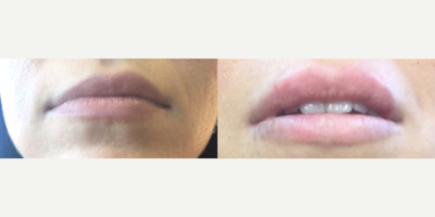 Dermal Fillers before and after photo