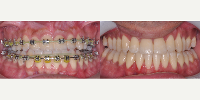 Jaw Surgery before and after photo