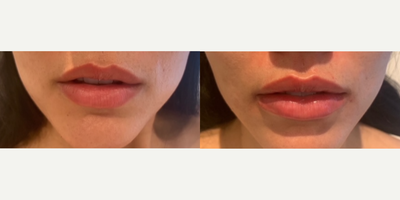 Lip Lift before and after photo