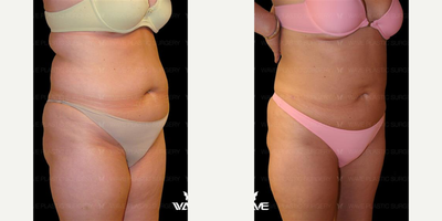 Liposuction before and after photo