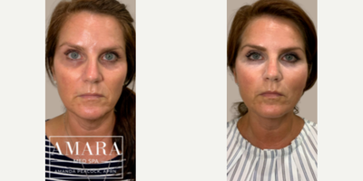 Thread Lift before and after photo