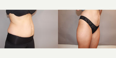 CoolSculpting before and after photo