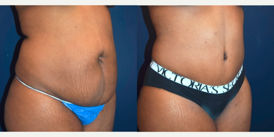Tummy Tuck before and after photo
