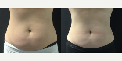 CoolSculpting before and after photo