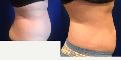 CoolSculpting before and after photo