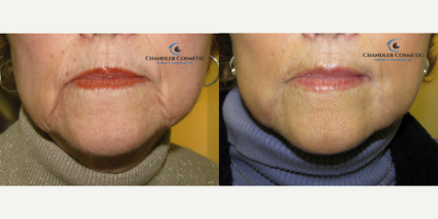Dermal Fillers before and after photo
