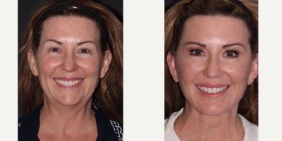 Eyelid Surgery before and after photo