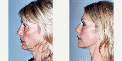 Facelift before and after photo