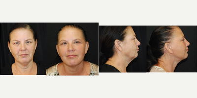 Facelift before and after photo