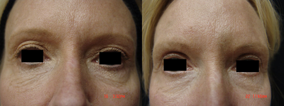 Fraxel Laser before and after photo