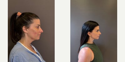 Neck Lift before and after photo