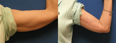 Arm Lift before and after photo