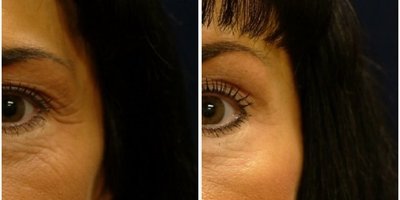 Botox before and after photo
