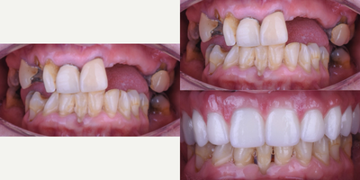 Dental Crown before and after photo