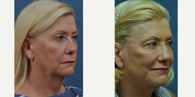 Facelift before and after photo