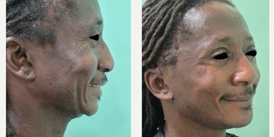 Facelift before and after photo