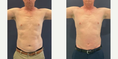 Liposuction before and after photo