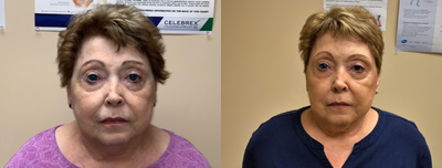 Bellafill before and after photo