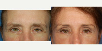 Brow Lift before and after photo