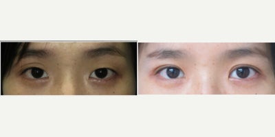Double Eyelid Surgery before and after photo