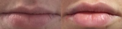 Restylane Defyne before and after photo