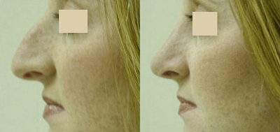 Rhinoplasty before and after photo