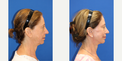 Double Eyelid Surgery before and after photo