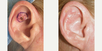 Ear Surgery before and after photo