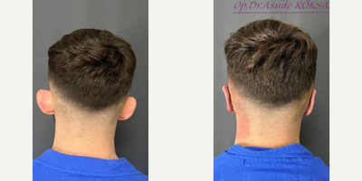 Ear Surgery before and after photo