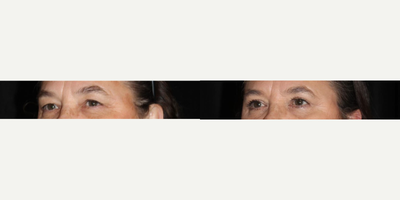 Eyelid Surgery before and after photo