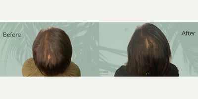 Hair Loss Treatment before and after photo