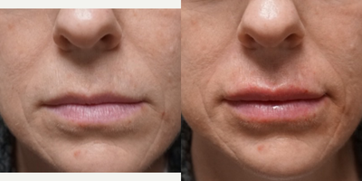 Lip Fillers before and after photo