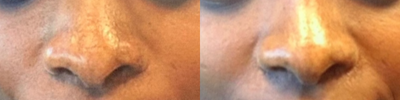 Nonsurgical Nose Job before and after photo