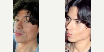 Bellafill before and after photo