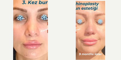 Revision Rhinoplasty before and after photo