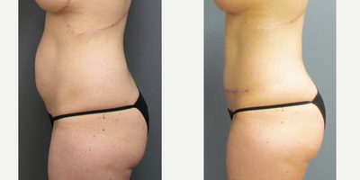 Tummy Tuck before and after photo